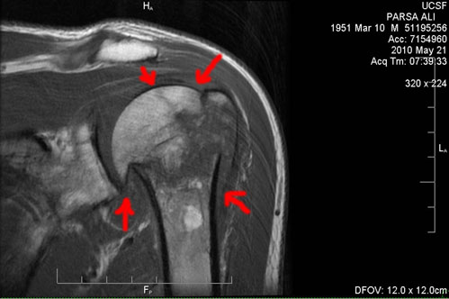 MRI of the fracture